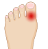 Rotura del dedo del pie