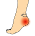 Heel pain