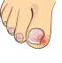 Ingrown Toe Nails