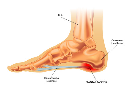 bony growth on heel