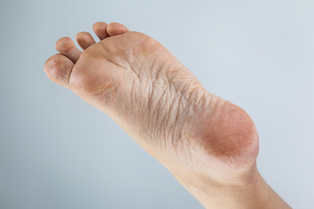 NEW Foot EXFOLIATING Peeling Mask Callus Dry Feet Hard Dead Skin Cracked  Heels | eBay