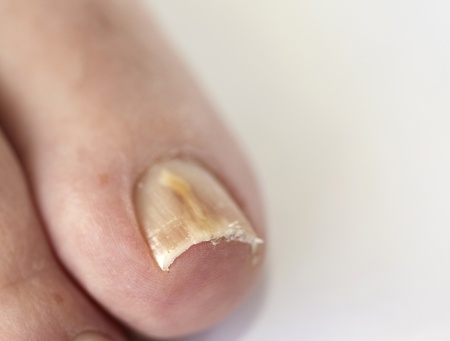 The Link Between Diabetes and Nail Fungus: Francine Rhinehart, DPM: General  Podiatrist