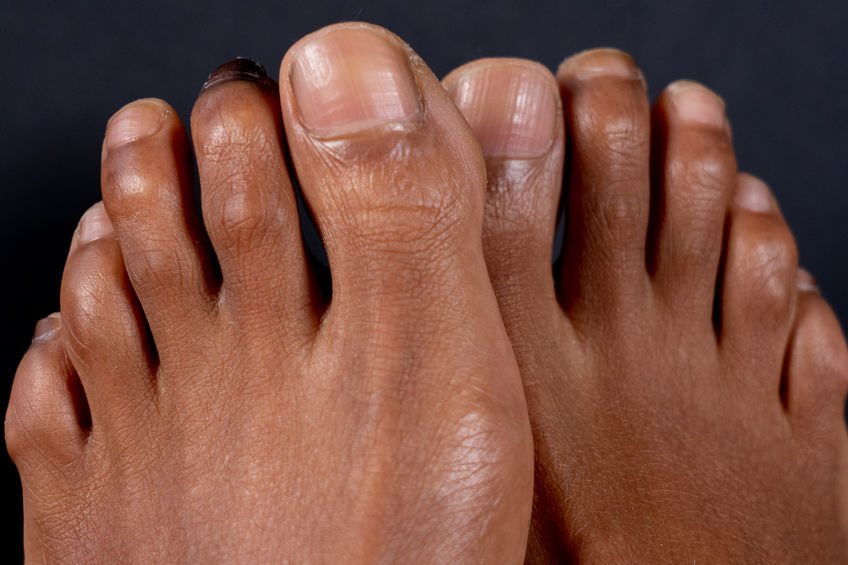 Big Toe Joint Pain — Fairfield Podiatry
