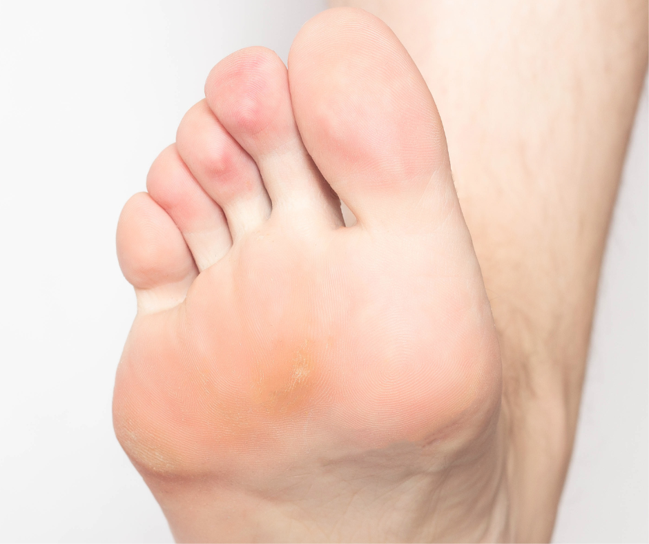 Foot Calluses : Your Questions Answered