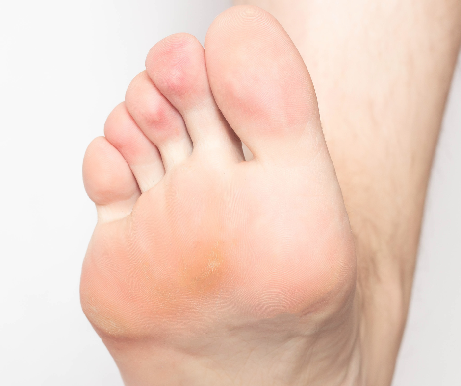 calluses  Podiatry Center of New Jersey