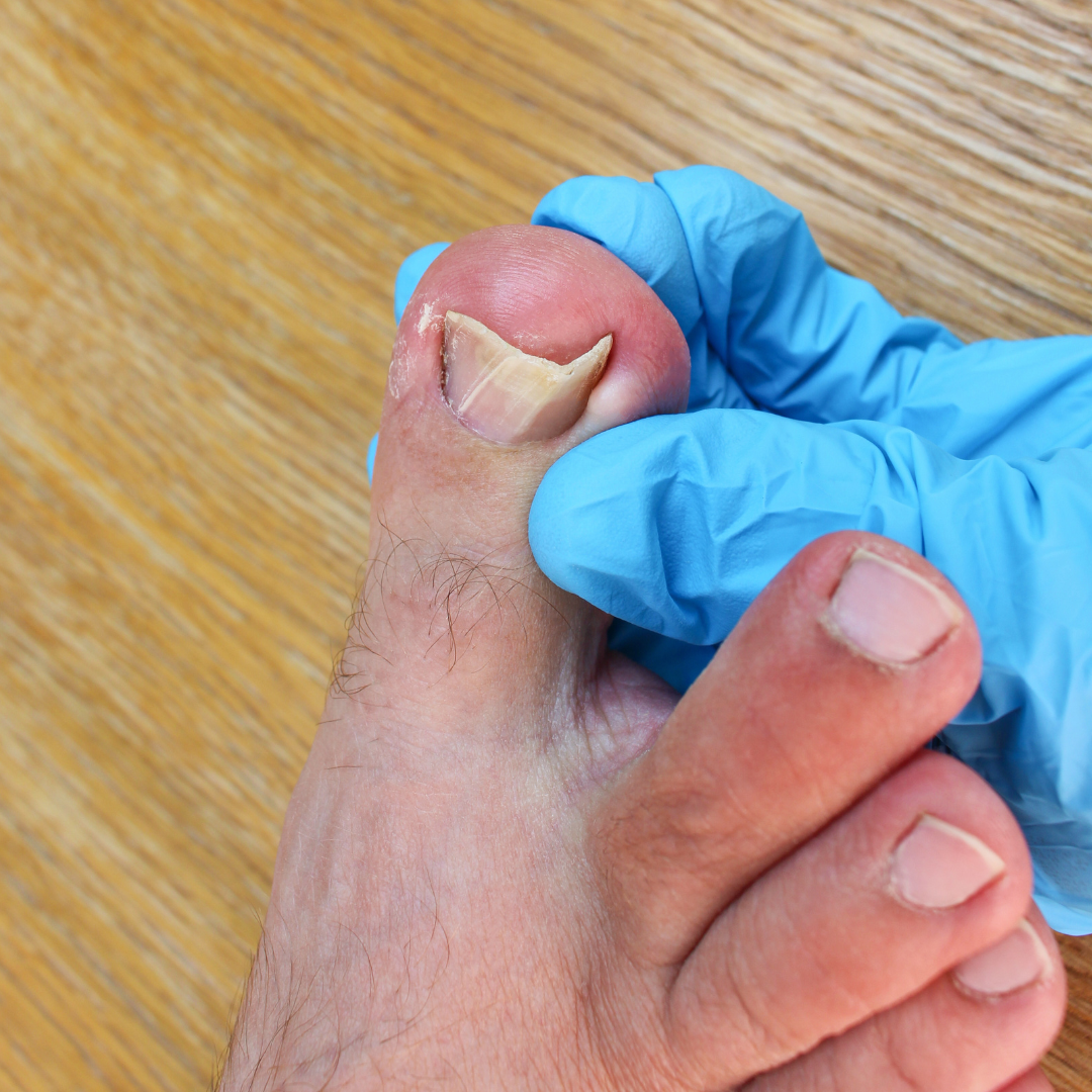 What You Don't Know About Ingrown Toenails Can Hurt You
