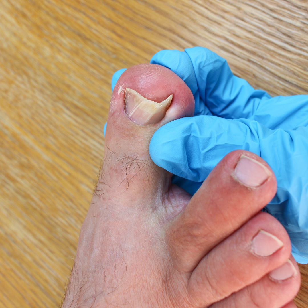 Ingrown Toenail Pain Relief - Your Foot And Ankle Clinic