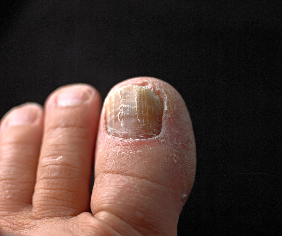 Fungal Nail Infection Treatment | Lunula cold laser - Mustard Seed Podiatry